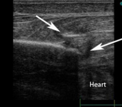 <p>You see this problem BEST on ultrasound (ie. better than radiographs)</p>