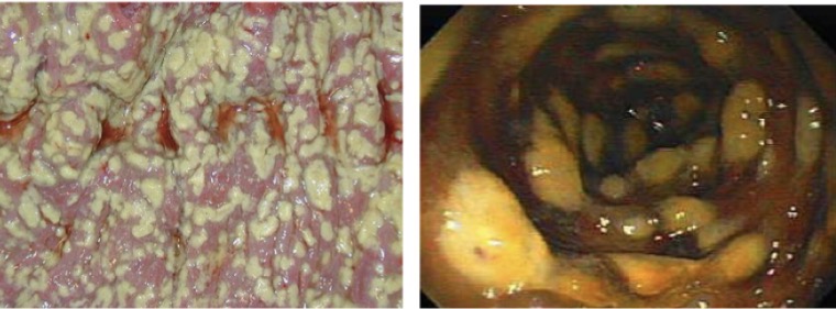 <p><span>The characteristic appearance of </span><strong>pseudomembranous colitis</strong><span>, with raised adherent yellow/white plaques or pseudomembranes over inflamed colonic mucosa.</span></p>