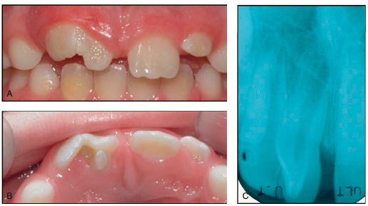 <p>2 crowns, 1 root</p><p>most common cause of <span style="color: red;">localized macrodontia</span></p><p><span style="color: red;">incomplete splitting (twinning)</span> of a developing primary or permanent tooth</p><ul><li><p>characteristics:</p><ul><li><p>total number of teeth remains normal.</p></li><li><p>produces a tooth that may be almost twice the width of a normal tooth</p></li></ul></li><li><p>etiology:</p><ul><li><p>no known genetic predisposition</p></li><li><p>no known hereditary cause.</p></li></ul></li></ul><p></p>