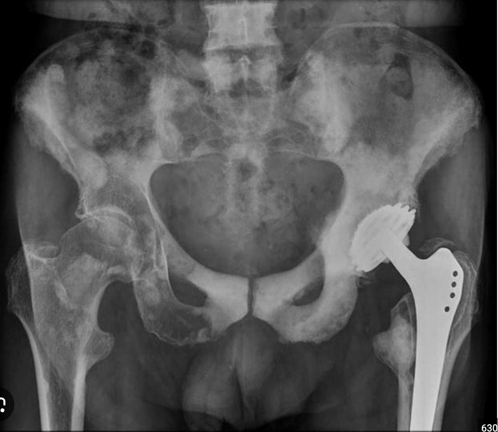 <p>Metastatic disease (lytic and blastic)</p>