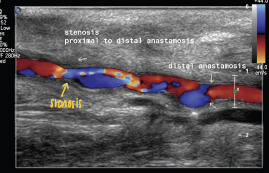 <p>rapid proliferation of cells into intimal layer → stenosis</p><ul><li><p>can occur along bypass conduit</p></li><li><p>occurs at: sustained injury or vein sinus</p></li></ul><p></p>