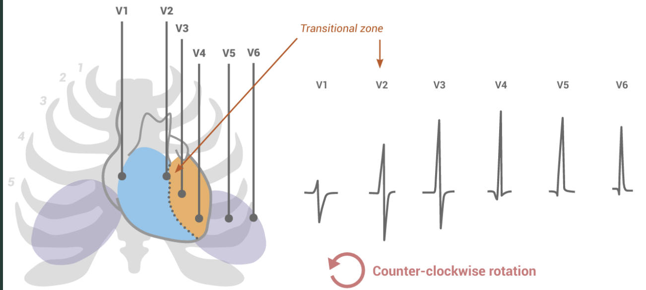 <p>CW; late transition seen in leads V5/V6</p>