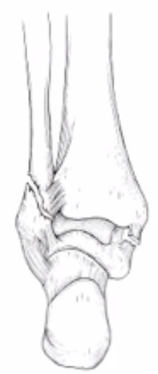 <p>What fracture is this?</p>