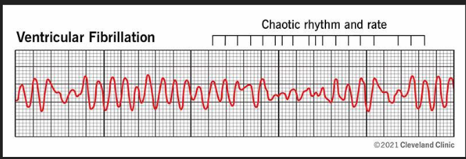 <p>Fibrillation refers to an irregular and rapid beating of the hearts chambers, which fails to pump blood effectively.</p><p></p><p>Instead of a coordinated depolarization, the ventricular muscle fibers “quiver” or fibrillate independently</p><p></p><p>Shockable rhythm! (Disorganized rhythm, Chaotic Pattern)</p>