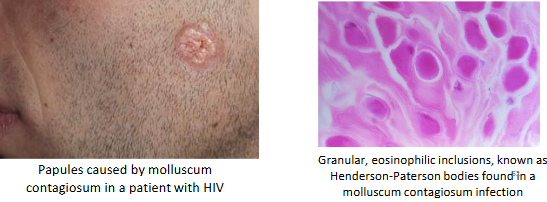 <ul><li><p>dsDNA virus, poxviridae</p></li><li><p>self-limited <strong>umbilicated</strong> (raised w/ center dimple) papular eruption (2-5 mm); severe = 15+</p></li></ul><p></p>