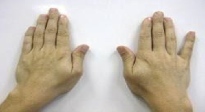 <ul><li><p><span>PURPOSE- Identify ulnar nerve neuropathy</span></p></li><li><p><span>DESCRIPTION- The patient sits with his or her hands resting on the table. The examiner passively spreads the fingers apart and asks the patient to bring them together again.</span></p></li><li><p><span>RESULT- Inability to squeeze the little finger to the remainder of the hand indicates a positive test for ulnar neuropathy</span></p></li></ul><p></p>