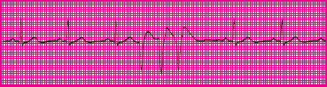 <p>Which rhythm is this?</p>