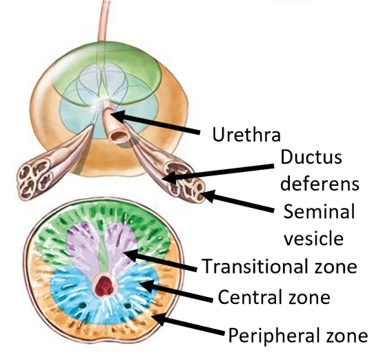 <ul><li><p><strong>Peripheral zone</strong>: site of where most malignant prostate cancers arise</p></li><li><p><strong>Central zone</strong>: surrounds ejaculatory ducts & urethra</p><ul><li><p>cancerous growth in this area would constrict the urethra</p></li></ul></li><li><p><strong>Transitional zone</strong>: site of <em>BPH</em></p><ul><li><p><em>Benign prostatic hyperplasia</em>: enlarged prostate but not asymmetrical i.e. not cancerous growth</p></li></ul></li></ul><p></p>
