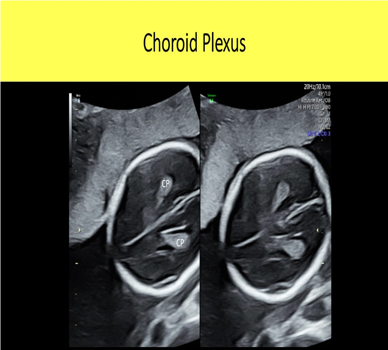 <p>C. choroid plexus</p><p>The lateral ventricles normally contain the choroid plexus.</p>