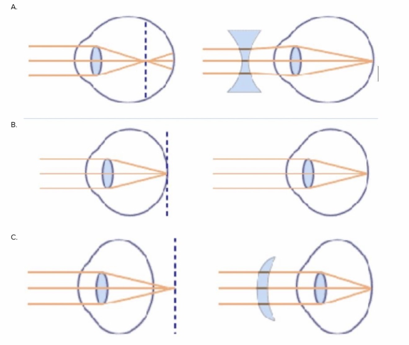 <p>Quelle représentation décrit le mieux un patient myope ?</p>