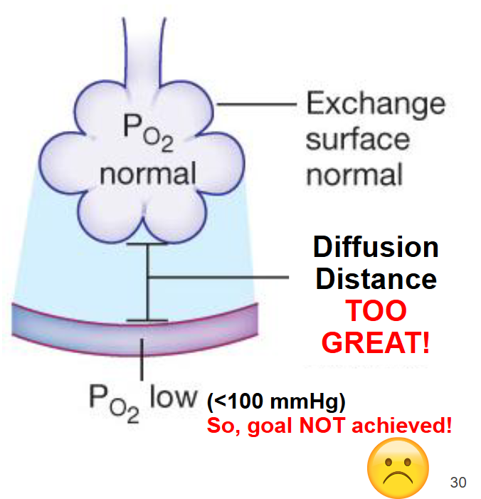 <p>When a patient presents with pulmonary edema, they have fluid accumulation in the interstitial space between the alveoli and pulmonary capillaries</p>