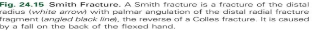 <p>Smith fracture</p>