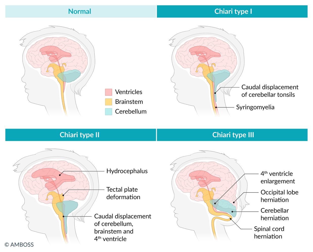 <p>chiari malformation type II</p>