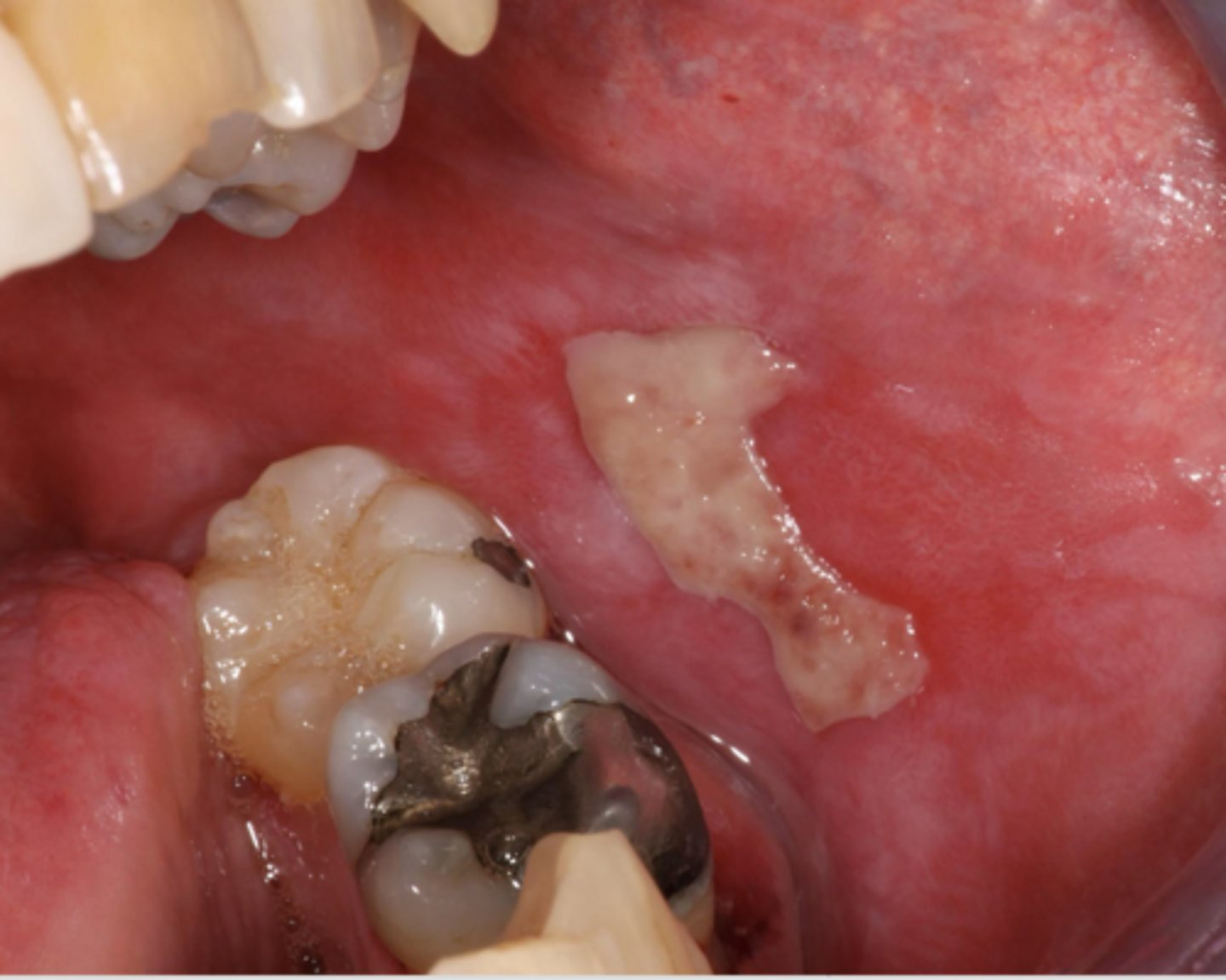 <p>What type of lichen planus?</p><p>- Least common form</p><p><strong>- Usually symptomatic</strong></p><p>- <strong>Ulcers w/ striae + erythema</strong></p><p>- May cause desquamative gingivitis</p><p>- Must be distinguished from mucous membrane pemphigoid or pemphigus</p>