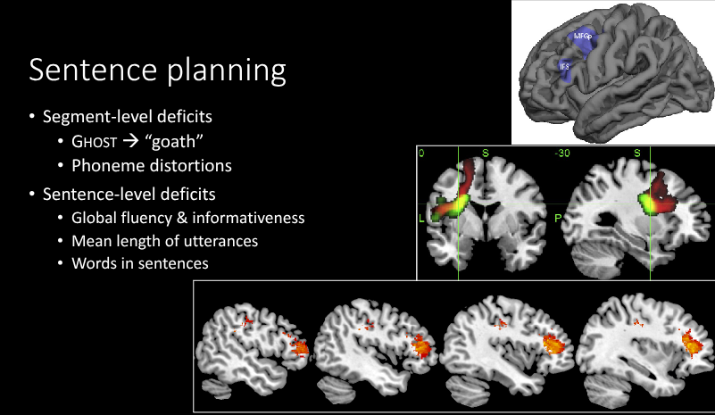 <p>Sentence-level deficits</p><ul><li><p>Global fluency + informativeness</p></li><li><p>Mean length of utterances</p></li><li><p>Words in sentences</p></li></ul><p></p>