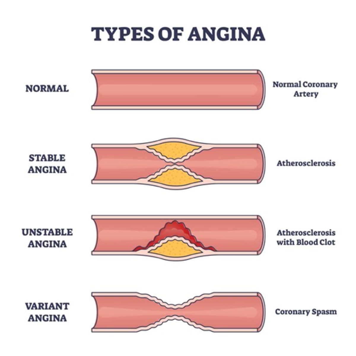 <p>A) Coronary vasospasm (rarely leads to heart attack)</p>