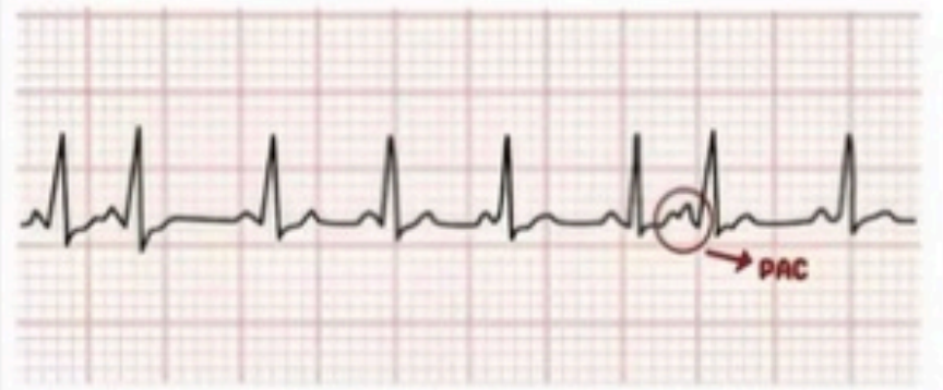 <p>abnormal or early p</p>