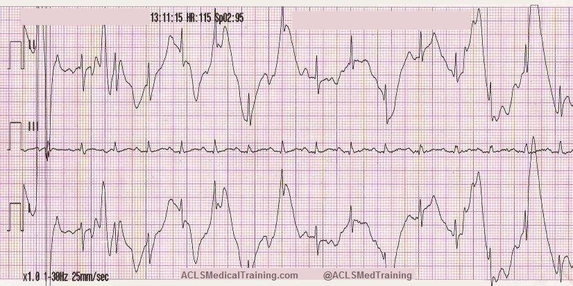 <p>this EKG strip is showing what rhythm?</p>