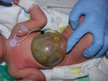 <p><span>omphalocele (ahm-fa-lo-seal)</span></p>