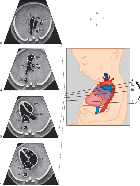<p>the following image demonstrates heart views in what order? (look at images top to bottom)** </p><ul><li><p>3 vessel trachea view, RVOT, LVOT, 4 chamber</p></li><li><p>LVOT, RVOT, 3 vessel view, 3V trachea view</p></li><li><p>four chamber, RVOT, # V view, LVOT</p></li><li><p>RVOT, 4 chamber, LVOT, 3v trachea view</p></li></ul><p></p>