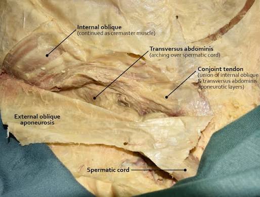 <p>A thick, fibrous band in the lower abdomen formed by the fusion of the internal oblique and transverse abdominis muscles that anchors to the pubic bone</p>