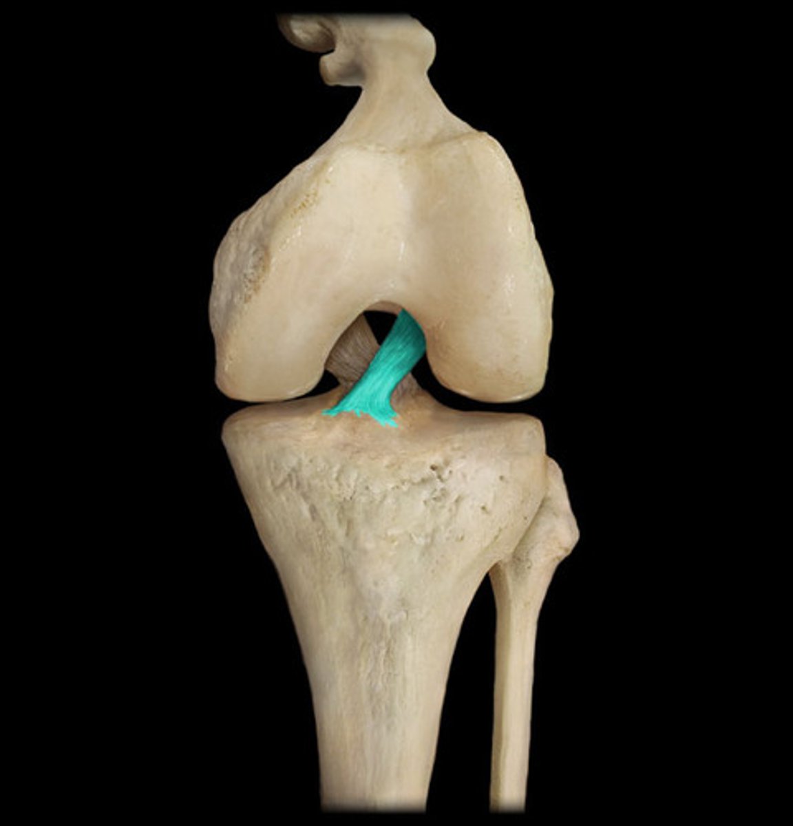 <p>A ligament in the knee that attaches to the anterior aspect of the tibial plateau. restricting anterior movement of the tibia on the femur</p>