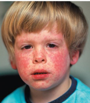 <ul><li><p>Viral disease transmitted by the <strong>respiratory route</strong></p></li><li><p>Cold-like symptoms, macular rash</p></li><li><p><strong>Pathogen → Morbillivirus</strong></p></li><li><p><strong>Method of transmission → Aerosol</strong></p></li><li><p>Koplik’s spots</p><ul><li><p>Red spots on the oral mucosa opposite the molars</p></li></ul></li></ul><ul><li><p>Prevented by the MMR vaccine <strong>(No treatment)</strong></p><ul><li><p>Children under 1 year old cannot receive the vaccine.</p></li></ul></li></ul><p></p>