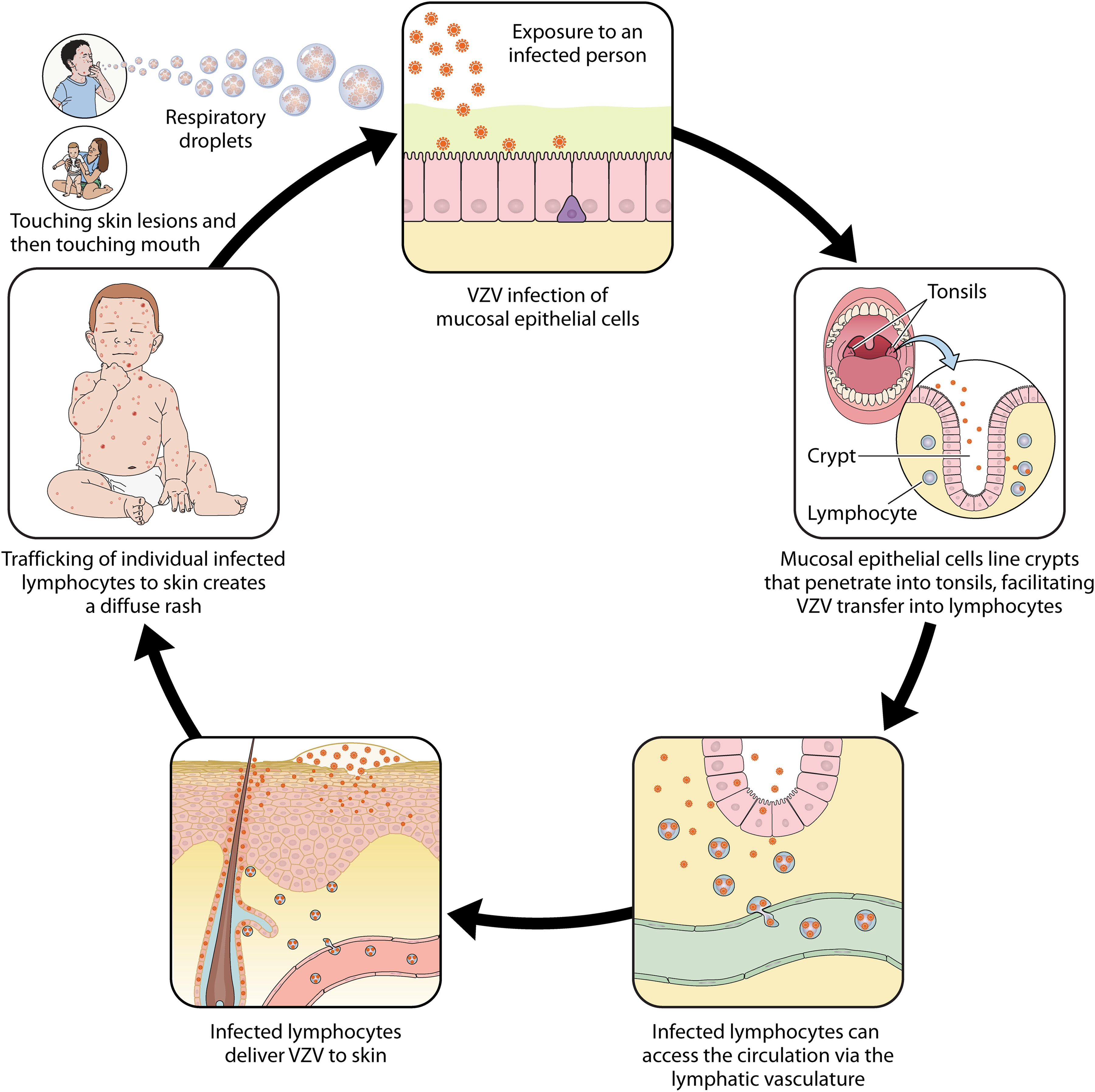 <p><strong>• Spread by respiratory droplets; </strong>typical childhood infection</p><p><strong>• Incubation period ~ 2 weeks</strong></p><p>• Targets epithelial cells in URT <span style="color: red;">before being spread by blood to skin </span>where it infects capillary endothelial cells and adjacent fibroblasts/epithelial cells</p><p>• Lesions progress from <strong>macules→papules→vesicles</strong> <span style="color: red;">then break down with crust formation</span>; mild in children more severe in adults</p><p>•<strong> Patients considered infectious from 2 days before rash</strong> and 4-5 days afterwards <u>until existing vesicles have crusted </u></p>