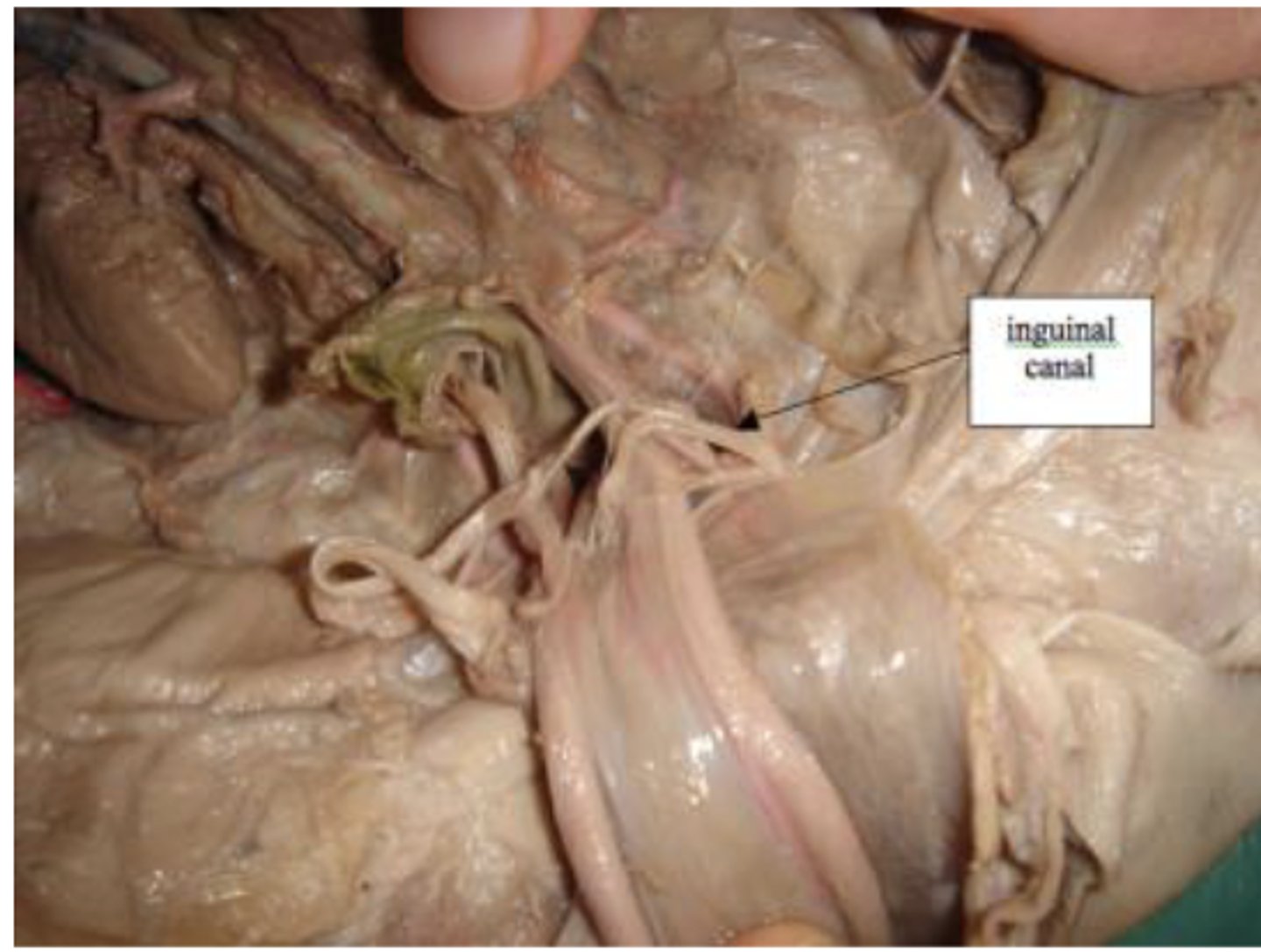 <p>passage in the abdominal muscle for the vas deferens</p>