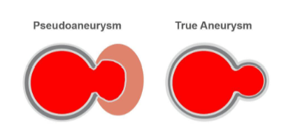 <p><span> It involves all three layers of the wall of an artery</span><br><span>(intima, media and adventitia)</span></p>