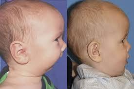 <p>what syndrome?</p>