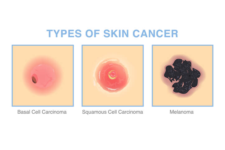 <p>skin biopsy. The test would reveal abnormal cells that are characteristic of basal cell carcinoma. They would present with enlarged nuclei, irrregular shapes, disorganized growth patterns. These cells invade surrounding tissues, FORMATION OF NODULAR LESIONS or ULCERATIONS on the skin. </p>
