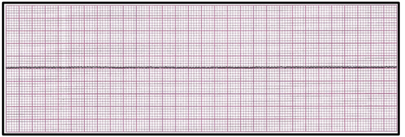 <p>Identify the above waveform:</p><p>a. asystole</p><p>b. monitor malfunction </p><p>c. A fib</p><p>d. fine V fib</p>