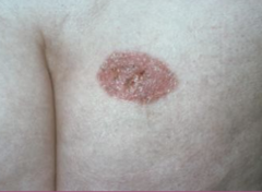 <p>Treatment: </p><p>1) ED&C; low-risk, in-situ SCC of torso</p><p>2) Mohs surgery; for lesions of head/neck & for invasive SCC</p><p>3) Standard Excision; for low risk and primary SCC lesions in non-cosmetically sensitive areas</p><p>4) Radiation Therapy: used for patients who are poor surgical candidates</p><p>5) Chemotherapy/Immunotherapy; used for high risk /advanced cases of SCC</p>