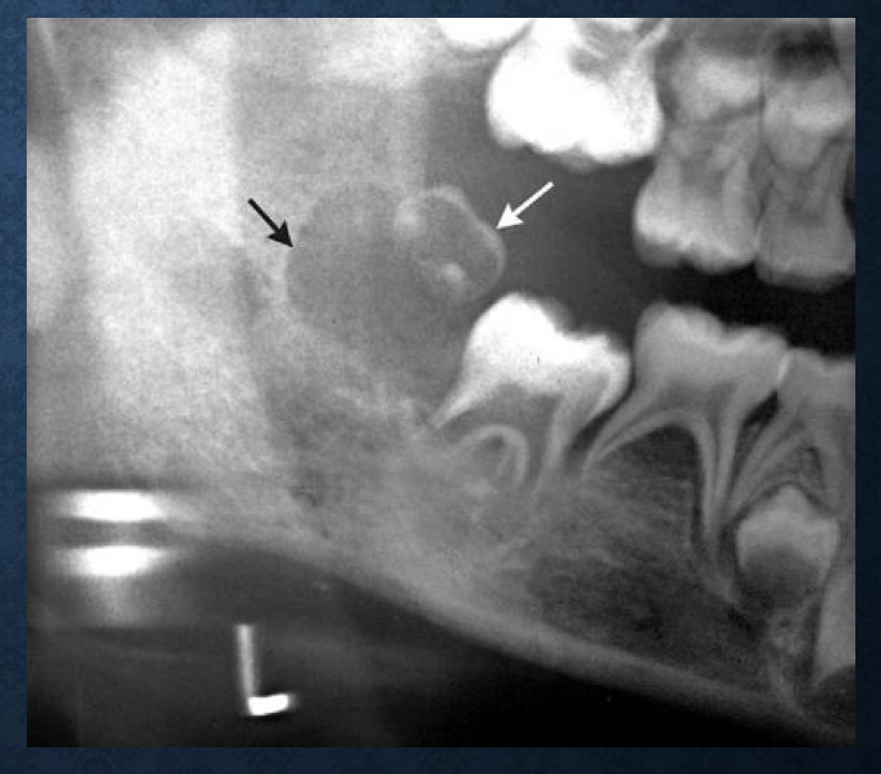<p>a lesion that superiorly displaces teeth is typically…</p>
