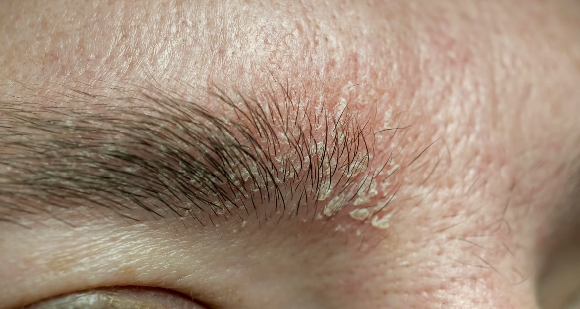 <p>What is seborrheic dermatitis?</p>