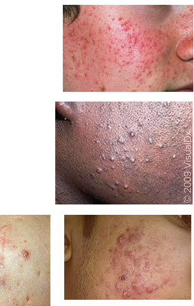 <ul><li><p>Follicle based comedones, inflammatory papules, and pustules</p></li></ul><p></p>