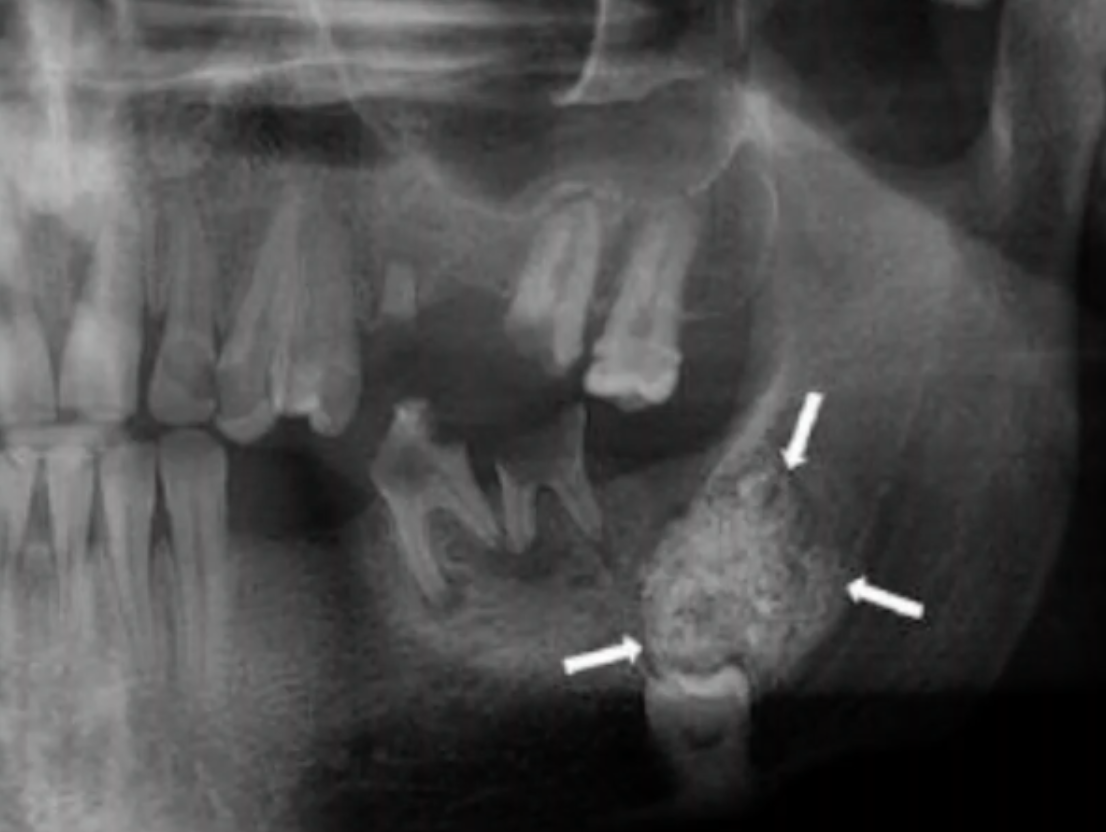 <p>what is the RADIOGRAPHIC TERM to describe the calcifications of CEOT </p>