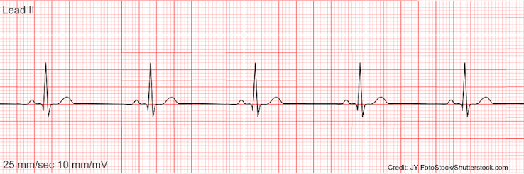 <p>what heart rhythm is this</p>