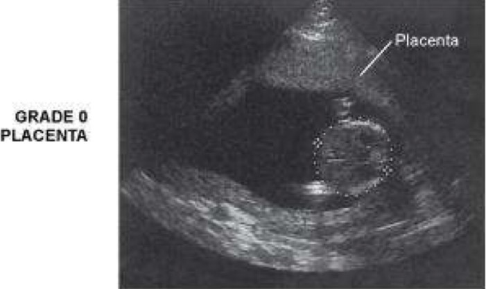 <p>Represents normal placenta; smooth chorionic plate; basal layer that is free of bright reflective densities; homogeneous; medium/low level echoes; may be interrupted by anechoic lacunae (small anechoic pools of maternal blood)</p>