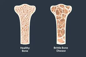 <ul><li><p>AKA brittle bone disease</p></li><li><p>genetic disease where bones don’t form properly = <strong>fragile/break easily</strong></p></li><li><p>present from birth and stays throughout life</p></li><li><p>impacts body’s production of collagen</p></li></ul><p></p>