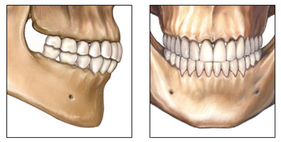 <p>Occlusion </p>