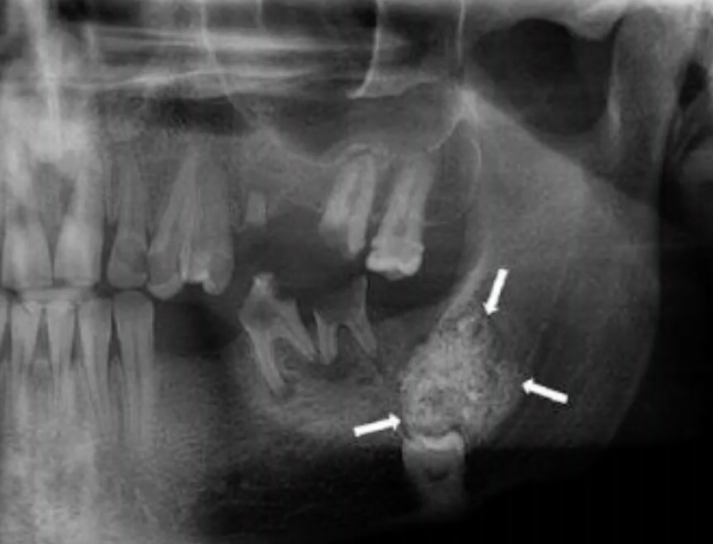<p>36 y/o female, slow growing, painless swelling, which is NOT in the differential ?</p><p>odontoma </p><p>dentigerous cyst </p><p>calcifying odontogenic cyst </p><p>calcifying epithelial odontogenic tumor </p>