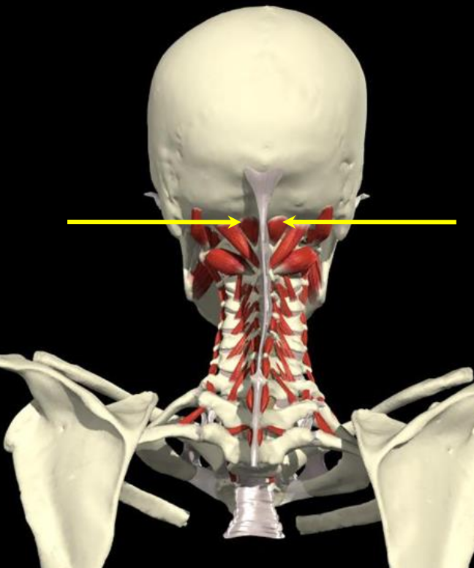 <p>O: occiput along the medial 1/3 of inferior nuchal line</p><p>I: post tubercle of posterior arch C1</p><p>N: dorsal ami C1</p><ul><li><p>extend head on C1</p></li><li><p>assist major with rotation C1-2 </p></li></ul><p></p>