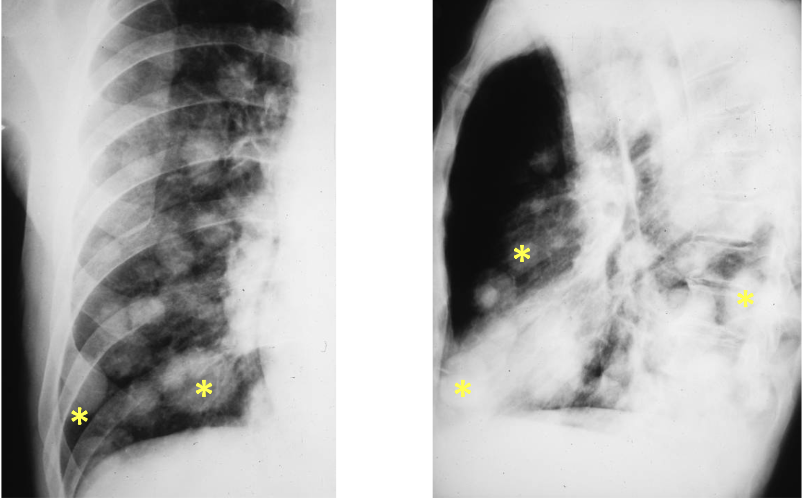 <p>What tumour like disorder is this?</p>