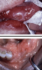 <p>Chronic granulomatous infection, mainly pulmonary caused by mycobacterium tb</p>