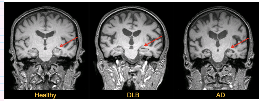 <ul><li><p>atrophy is greater in alzheimer’s diseases (AD) than in dementia with lewy bodies (DLB)</p></li><li><p>atrophy of medial temporal lobes structures most likely in AD</p></li></ul><p></p>