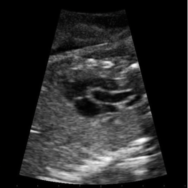<p>Which cardiac view of the fetal heart is demonstrated on the image?</p><p>A. RVOT</p><p class="p1">B. Ductus arteriosus</p><p class="p1">C. LVOT</p><p class="p1">D. Ductus venosus</p>