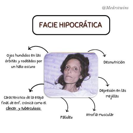 <p>Esta facie, se define por la nariz y demás rasgos fisonómicos afilados, los ojos hundidos en las órbitas y rodeados de un halo oscuro, la piel de color terroso pálido, cubierta de sudor frío y pegajoso <br>Cianosis de la mucosas, lengua seca y labios agrietados  </p>