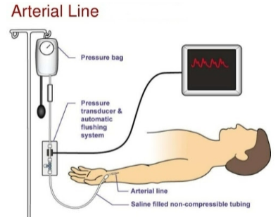 <p>BP and blood samples can be taken. includes a fluid bag connection to ensure clots don’t form (clotted artery creates surgical emergency)</p><p><strong>mean arterial pressure (MAP):</strong></p><ul><li><p>(SBP + [2 x DBP]) / 3</p></li><li><p>if >65, organs are perfused. 65-110 good</p></li><li><p>always calculate MAP</p></li></ul><p></p>